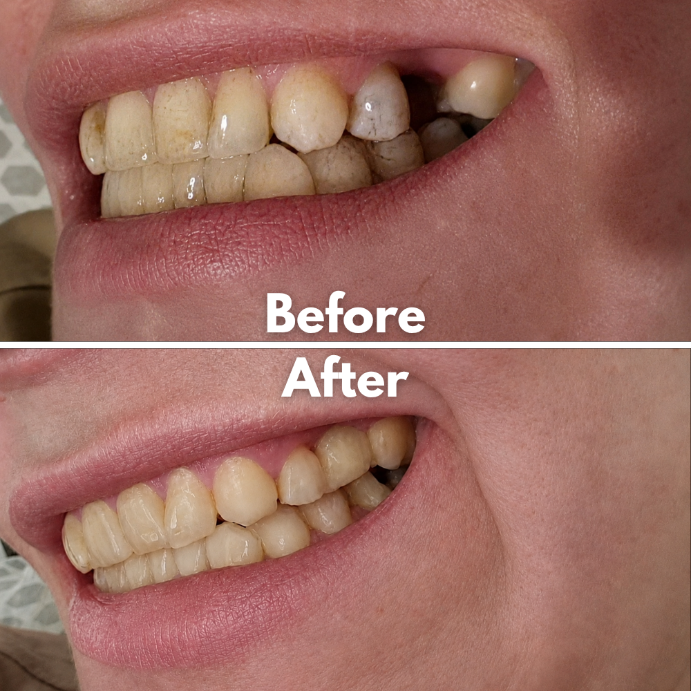 Moldable Gel Dentures